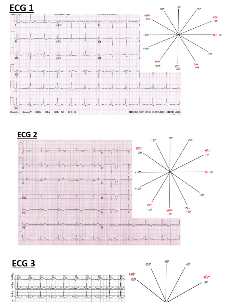 Ecg | PDF