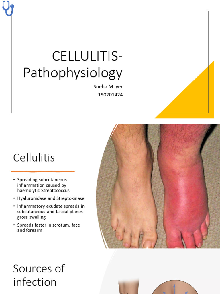 Cellulitis | PDF