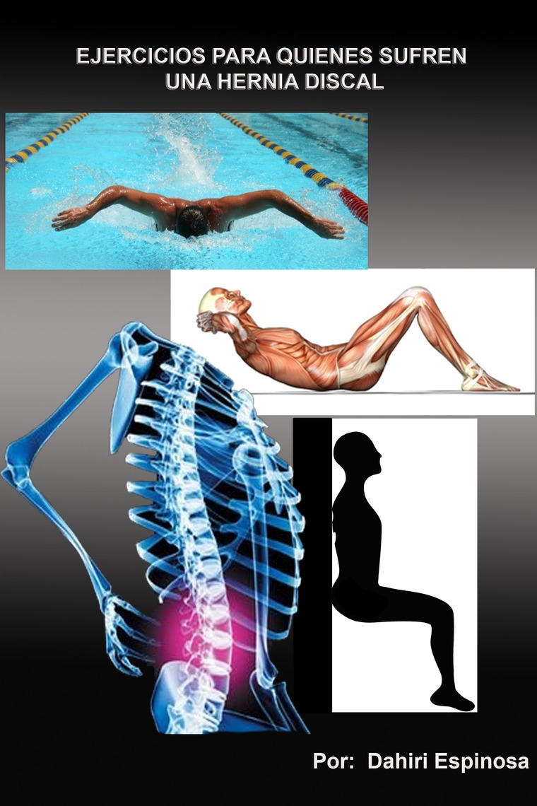 Se Puede Hacer Pesas Con Hernia Discal