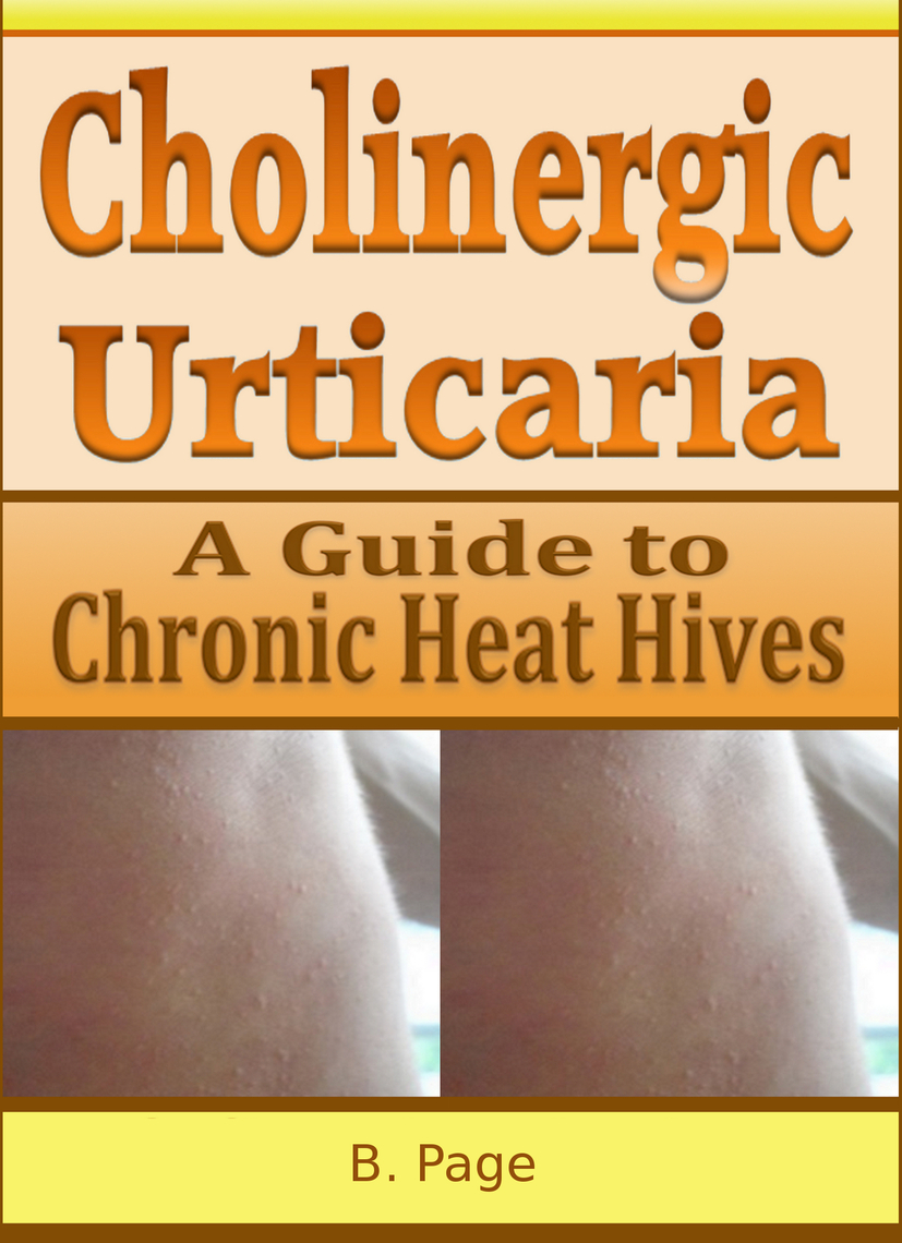 Cholinergic Urticaria A Guide to Chronic Heat Hives by B Page Book
