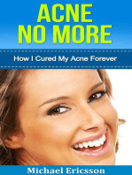 Acne No More: How I Cured My Acne Forever