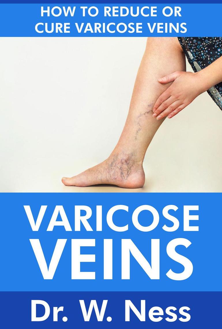 Reete populare pentru picioarele varicoase