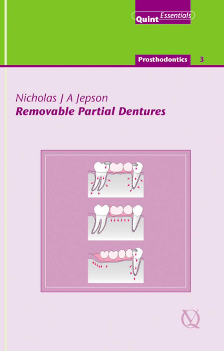Read Removable Partial Dentures Online by Nicholas J. A. Jepson Books